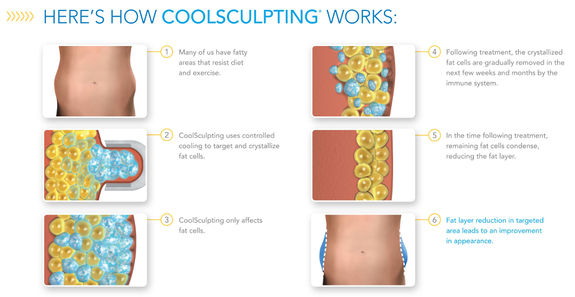 How Coolsculpting Works